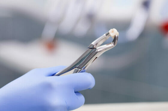tooth_extraction_01