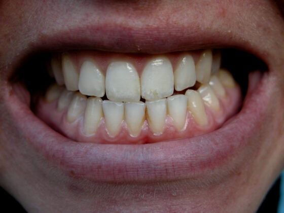 bruxism_effects_01